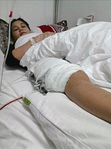 大腿骨折手术后,恢复良好,为什么膝盖不能弯曲