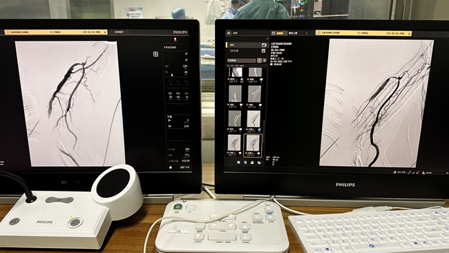 龙港中医院首例前臂动静脉瘘造影及球囊扩张术