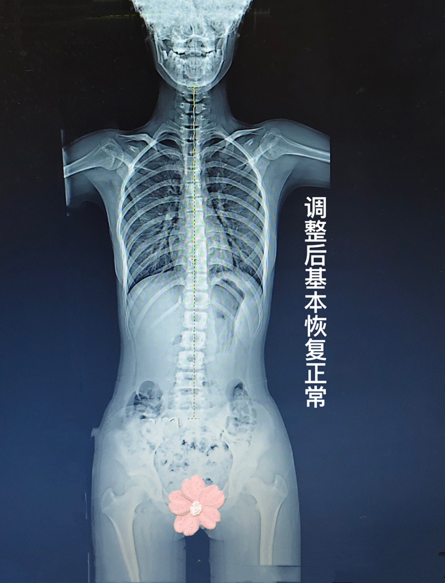 11岁女孩脊柱侧弯15度 11天体态养护后影像对比向好 11岁女孩脊柱侧弯15度 11天体态养护后影像对比向好