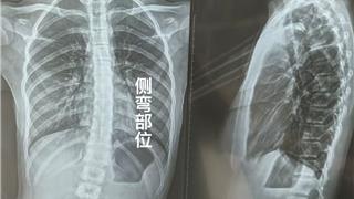 11岁女孩脊柱侧弯15度 11天体态养护后影像对比向好 家长分享经历提醒重视筛查